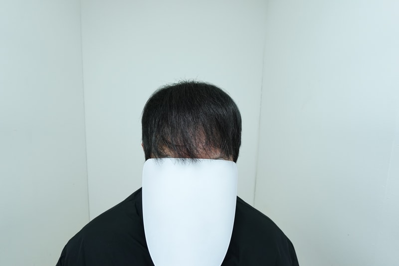 재수술 정면.jpeg