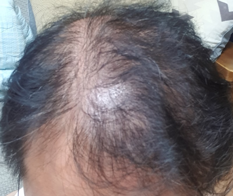 모재성 성형외과 8개월차 후기입니다.
