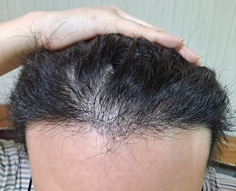 3. 수술후_6개월_셀카1.jpg