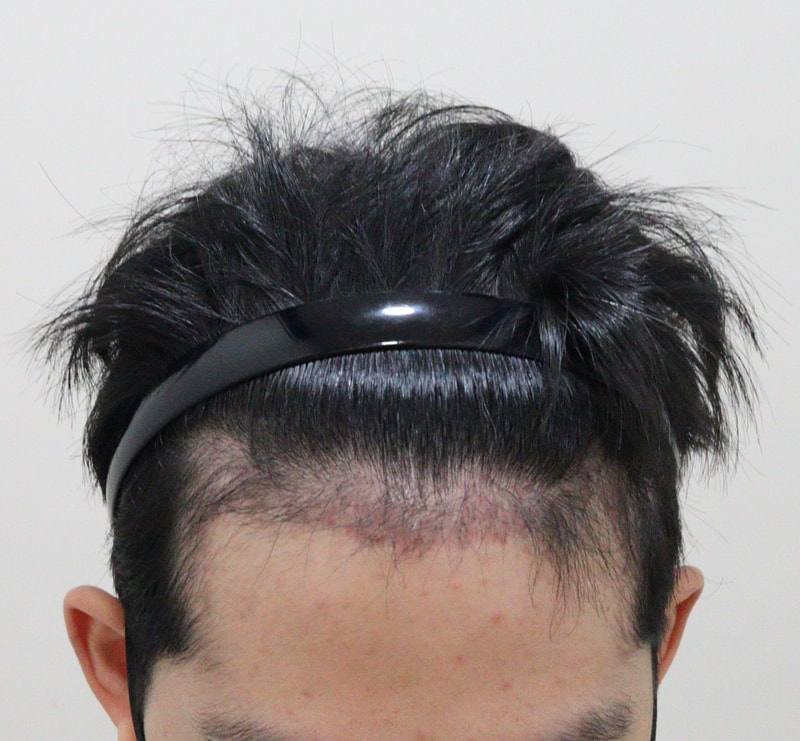 3. 수술후_3개월_1.JPG