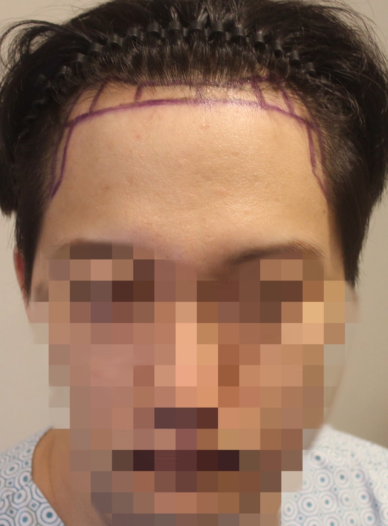 뉴헤어(서울) 무삭발 비절개 1100모낭 2일차 후기