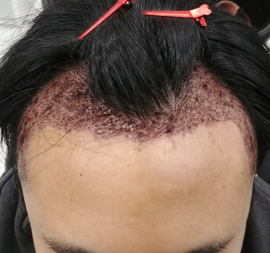 2일차(샴푸후 사진).jpg