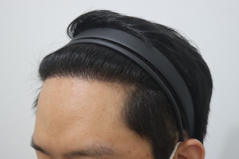 It's been 12 months since the 3200 hair transplant!