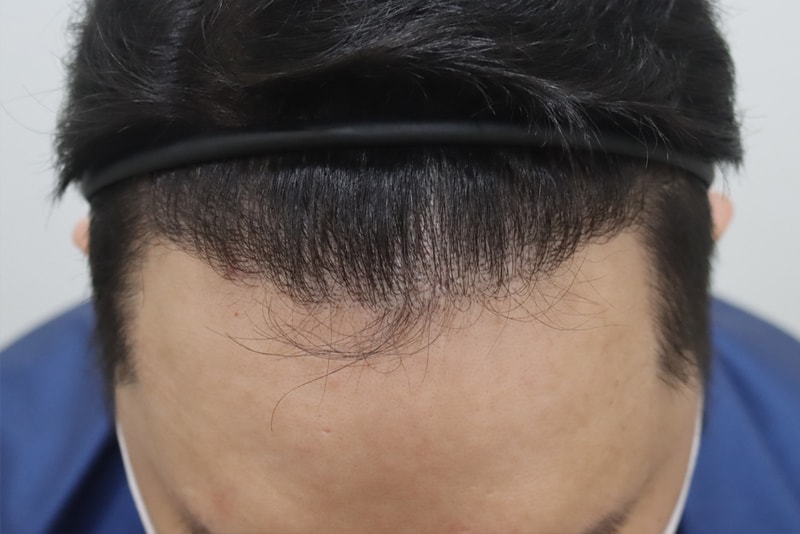 3500모 히든컷 6개월
