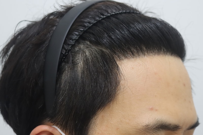 모스트 무삭발 비절개 9개월입니다