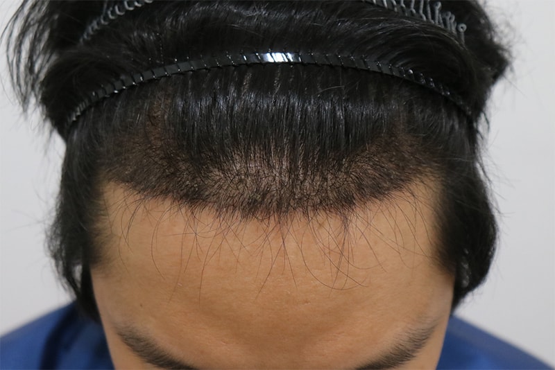 수술 후.jpg