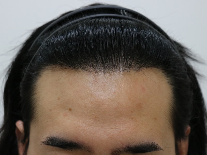 수술 후 1.jpg