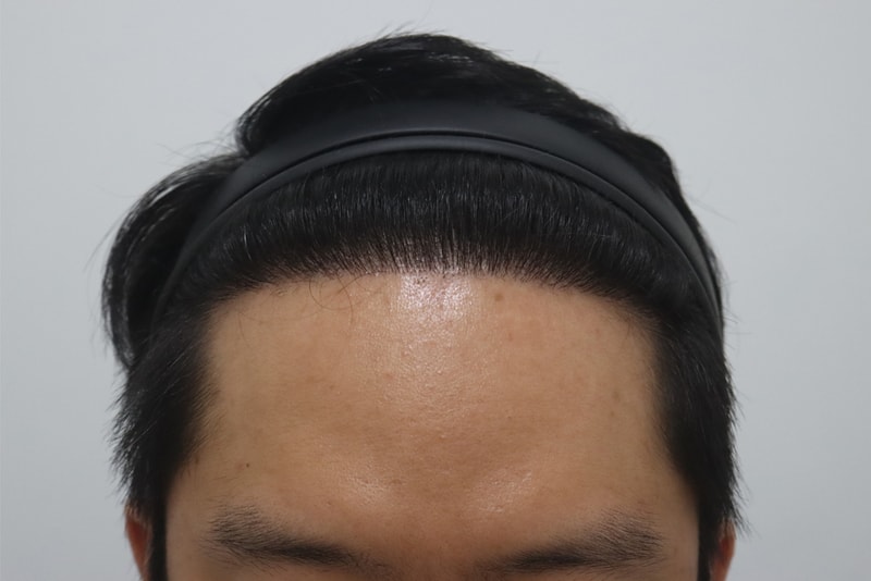 수술 후.jpg