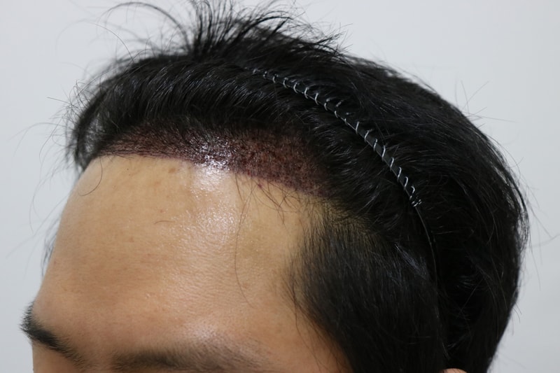 수술 후 3.jpg