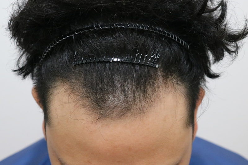 비절개 모발이식 2주 기록