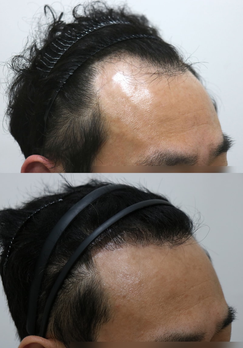 이식 6개월 다들 화들짝 놀랩니다 ^^