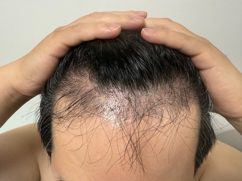 Hair condition in the 4th month of transplantation ^^~