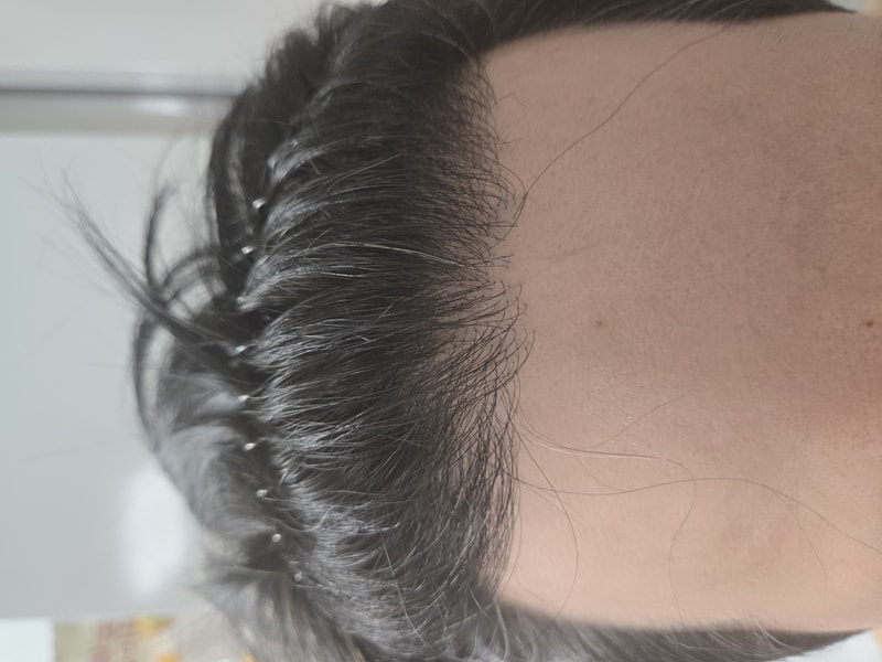 This is the end of hair follicle transplantation in the 9th month.