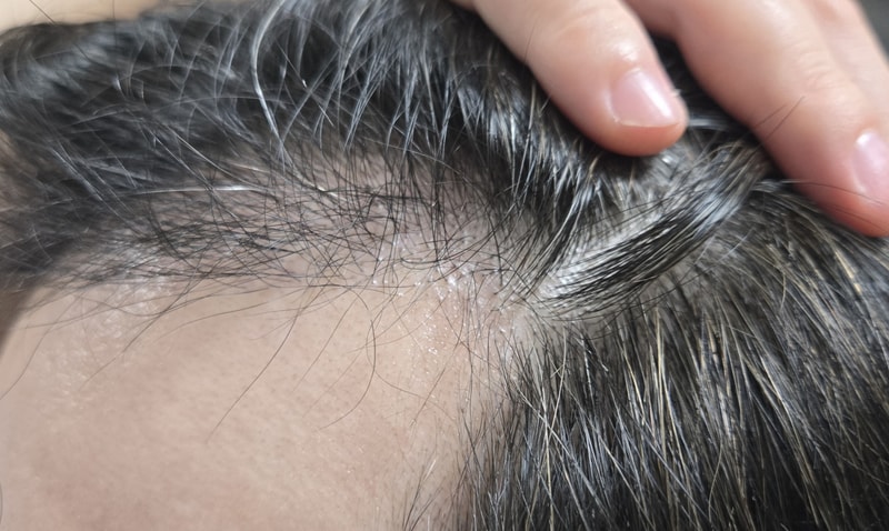 This is the 5th month of hair follicle transplantation. I feel good