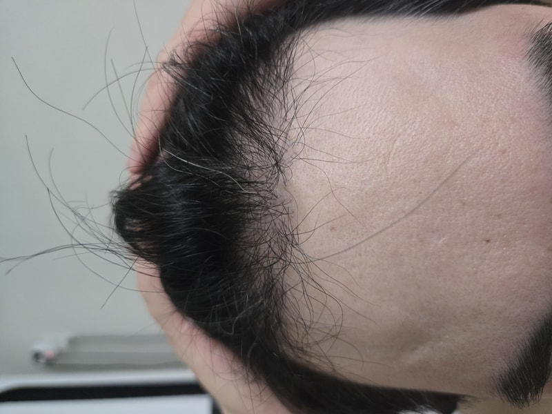 6 months progress report of hair follicle transplantation