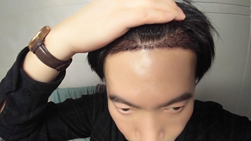 4월26일 뉴헤어에서 슬릿 절개 3000모 했습니다