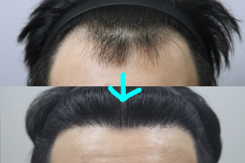 모나라피부과 M자에 3000모 모발이식 최종경과!