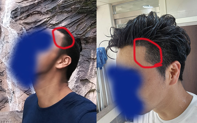모나라피부과에서 측면 라인 모발이식 4개월 각이 예술입니다~