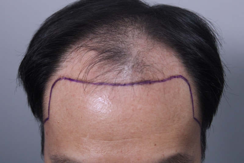 It's been 4 months since I got a hair transplant