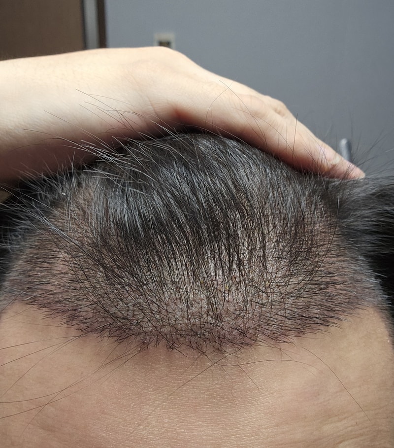 Day 14 of 2000 follicle transplantation to M-shaped, lateral, and sideburns