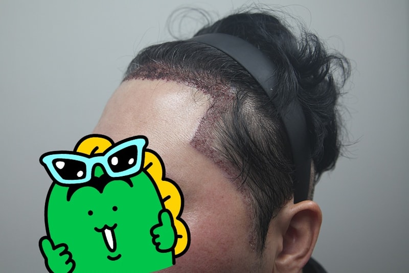 모나라피부과 모발이식 3.jpg