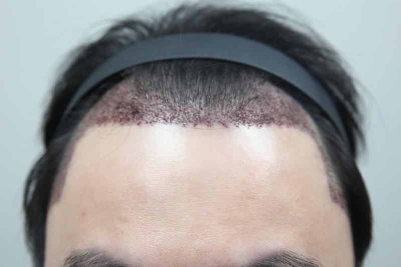 2,000 hair follicles transplanted to the M-shape, side, and sideburns.