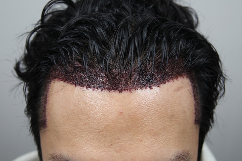 Re-surgery for Hair Transplant I did it in my country! (1st 5 years ago, another hospital)