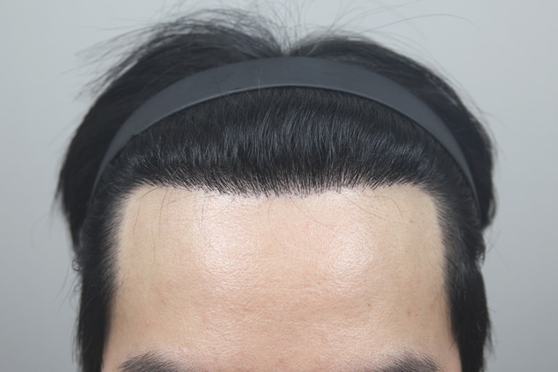 모나라피부과 3000모 8개월 미친 경과! 대만족합니다!