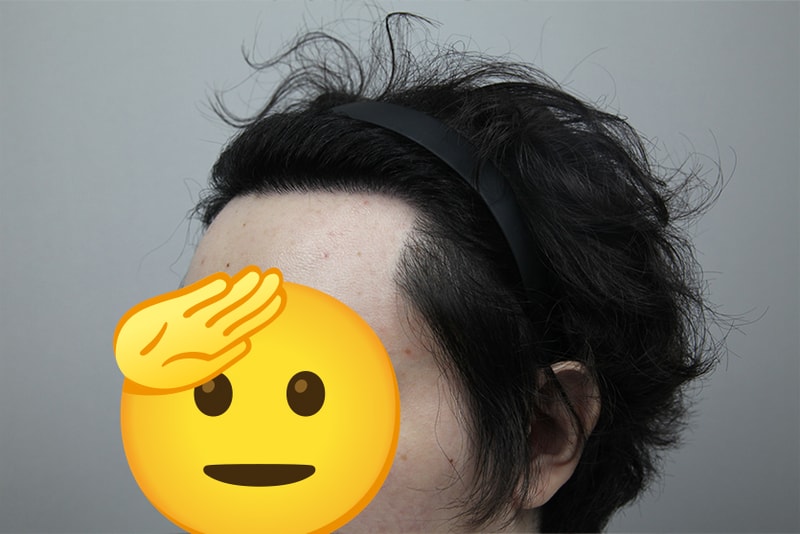 모나라피부과 모발이식 1년, 대성공!!!!!