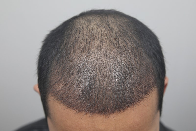 Monara 5000 Mo's head goes up to 1 month! (Characteristic of curly hair)