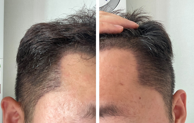 피부과전문의 모나라피부과에서 모발이식 2주됐어요!