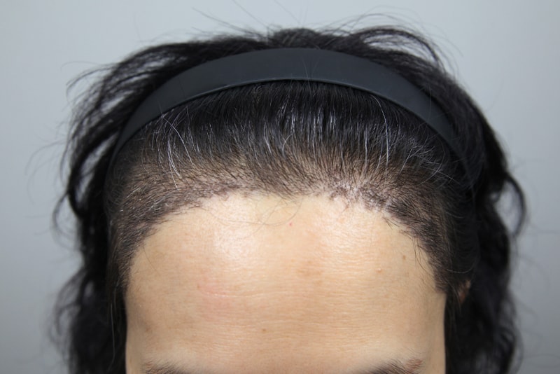 각진 헤어라인, 둥글게 헤어라인 교정 모나라 김대우 원장님에게 2주차