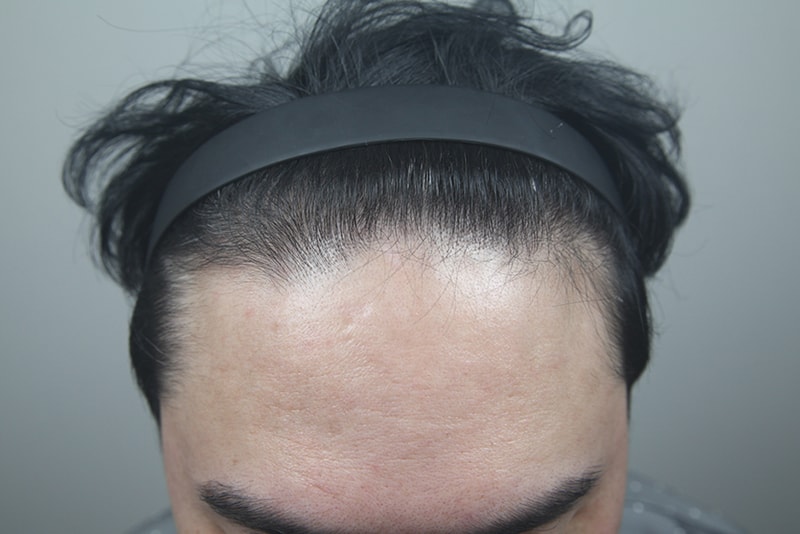 모나라피부과 모발이식 2 3.jpg