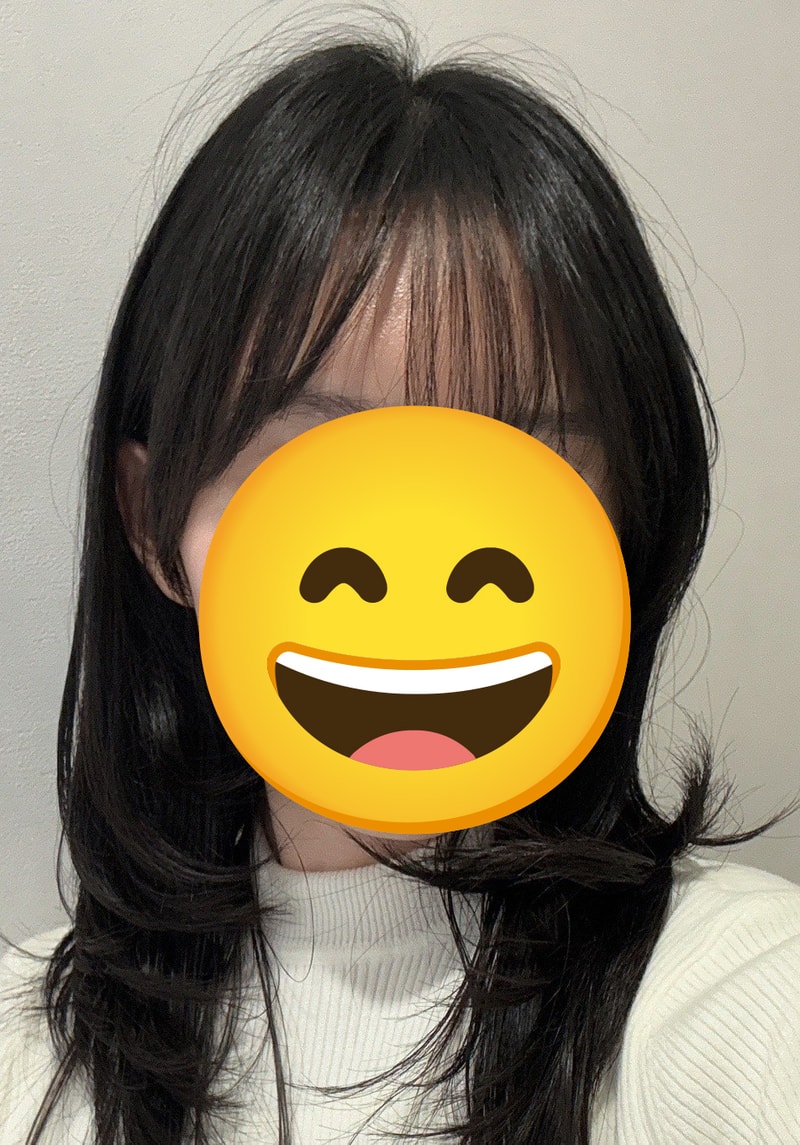 모나라피부과 여성 헤어라인 교정 3800모 4달차 후기