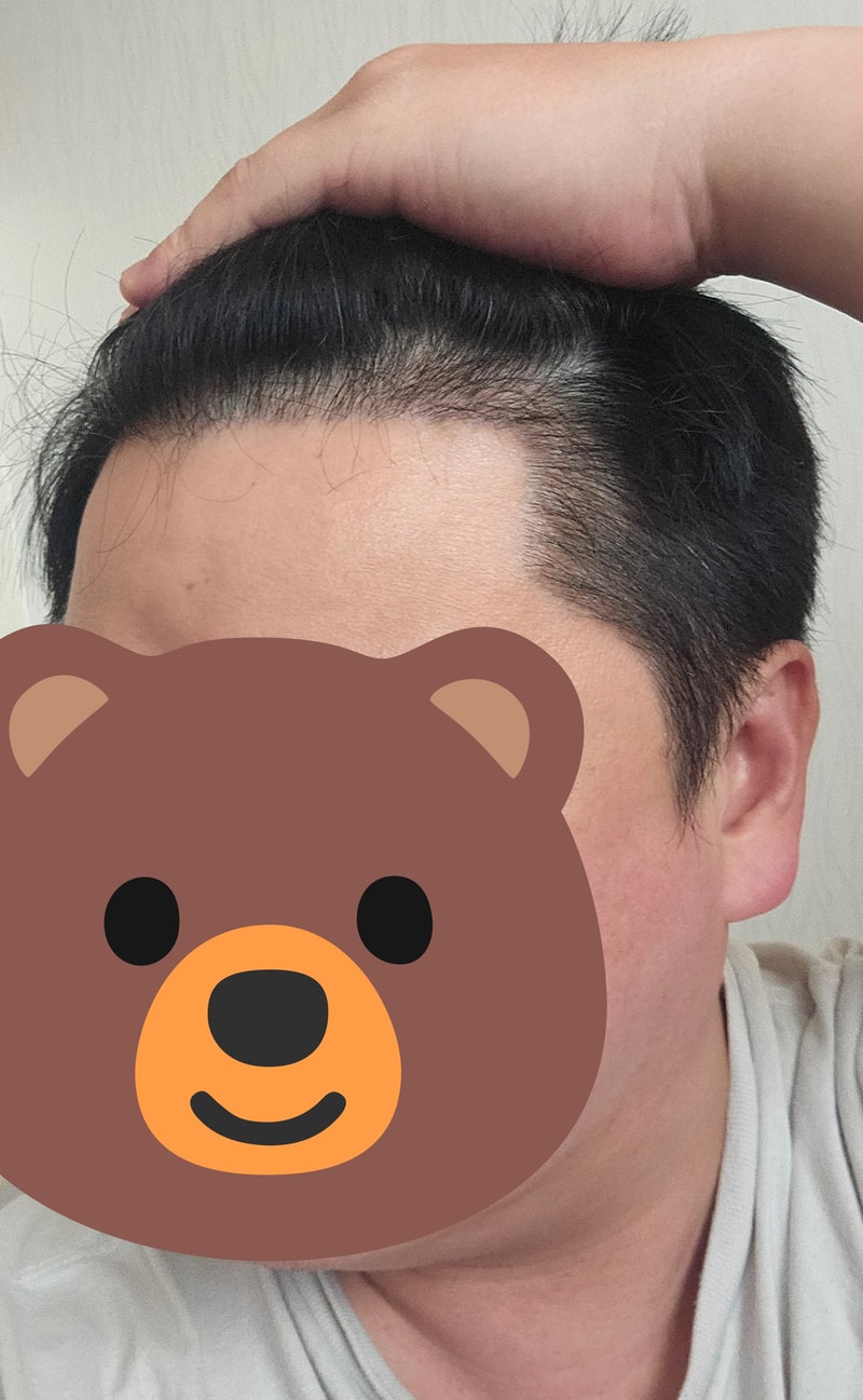 From hairline to sideburns, it's been 4 months since I started Hair Transplant.