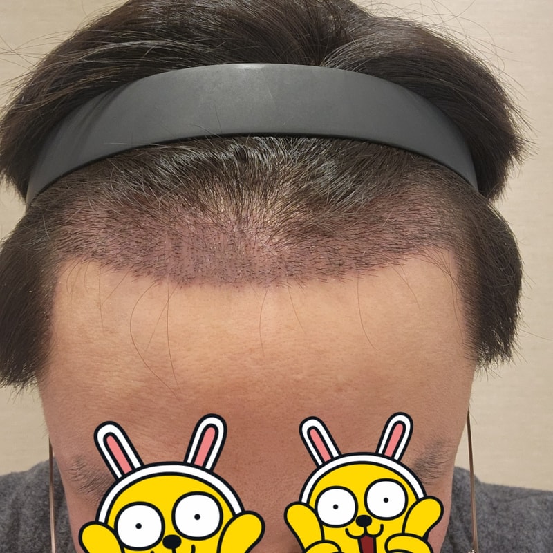 모나라피부과에서 모발이식하고 2주 됐어요~~