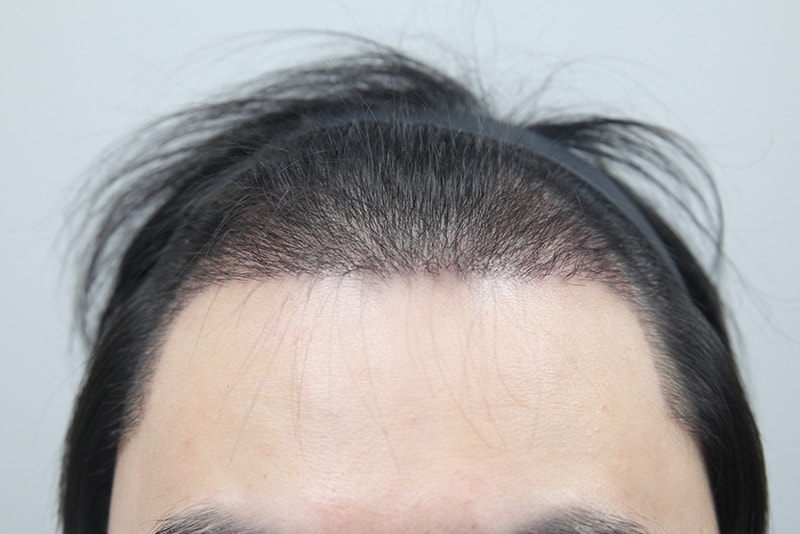 2000 hair follicles 1 month to M-shape, side, and sideburns