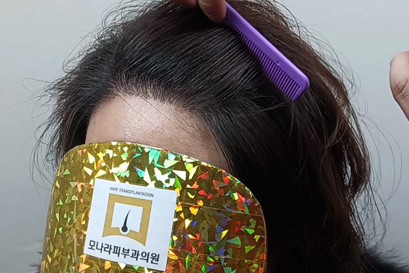 모나라모발이식-3.jpg