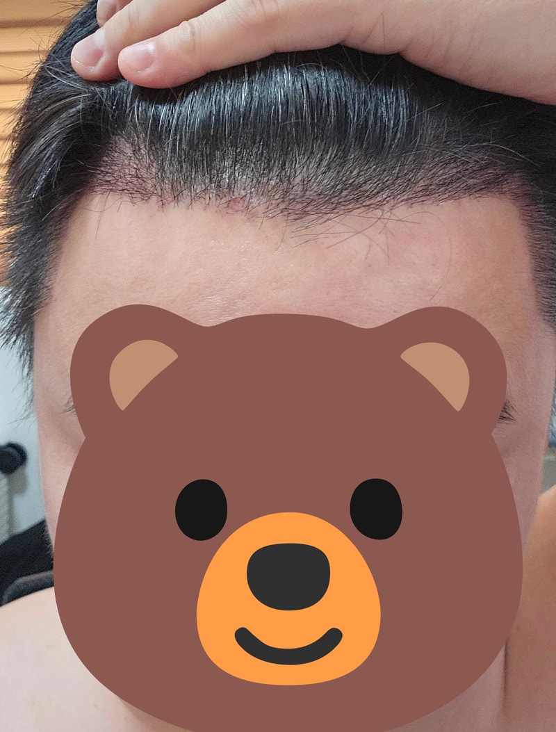 From the hairline to the sideburns, it's been a month since I transplanted my hair