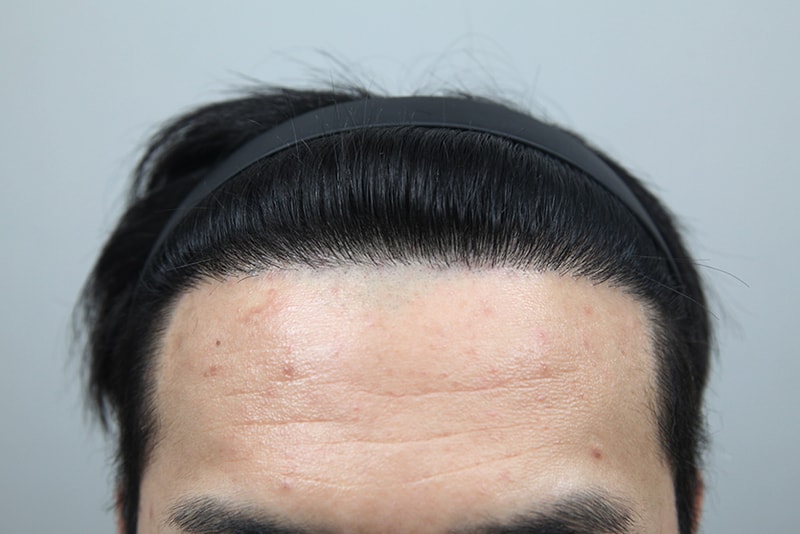 모나라에서 깊은 M자 모발이식 전부터 1년까지 사진 총정리!