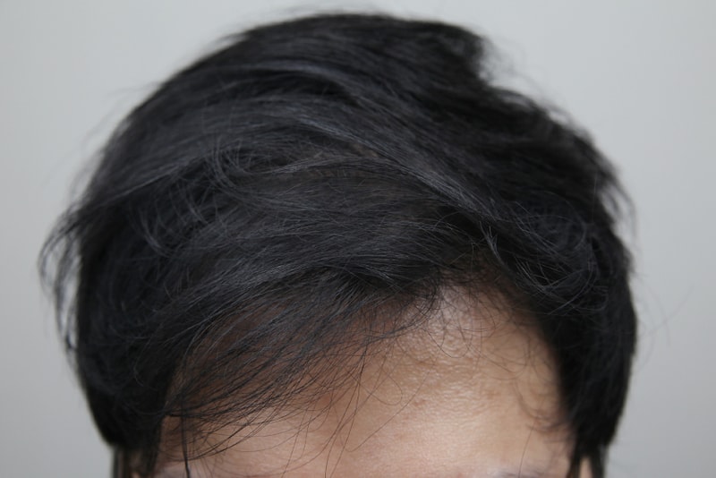 모나라모발이식_정수리모발이식 4.JPG