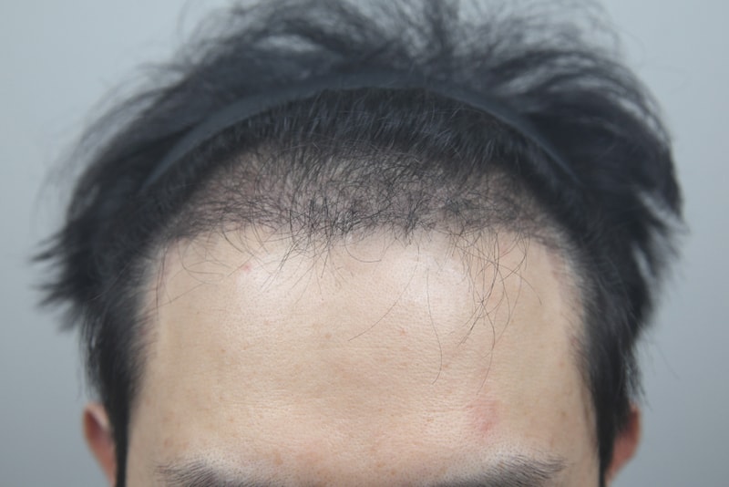 4000모 모발이식 받고 암흑기 끝난거 같아서 후기남겨요~