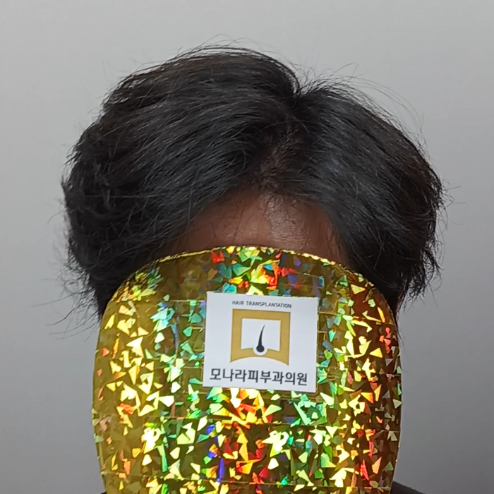 모나라모발이식 3.jpg