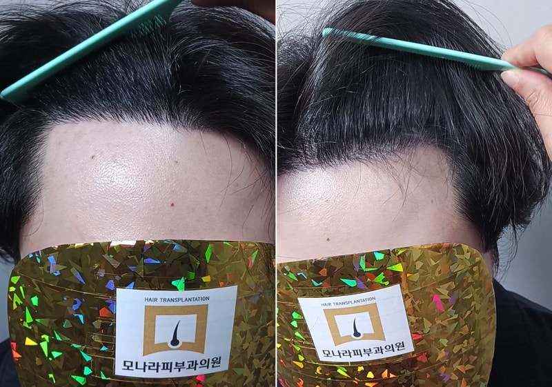 모나라피부과 모발이식 8개월, 대성공!?