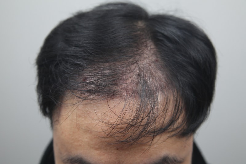 10년전 1차 수술, 모나라에서 재수술 1개월 됐어요! 암흑기 시작?