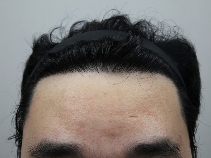 모나라피부과 모발이식 2000모낭 8개월 경과
