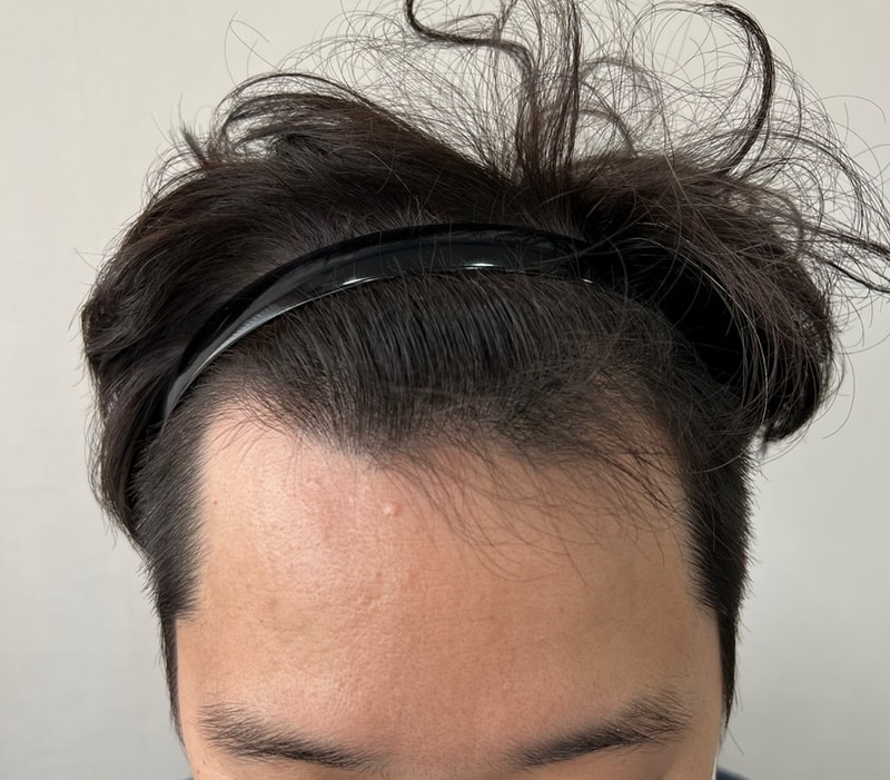 1200모낭, M자, 비절개, 모발이식 2일차!