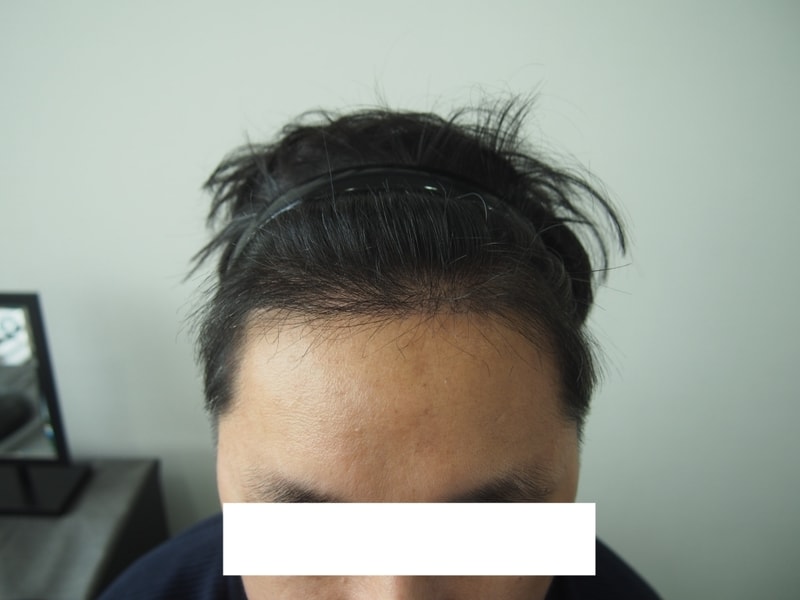 수술4개월후기 원장샘문답