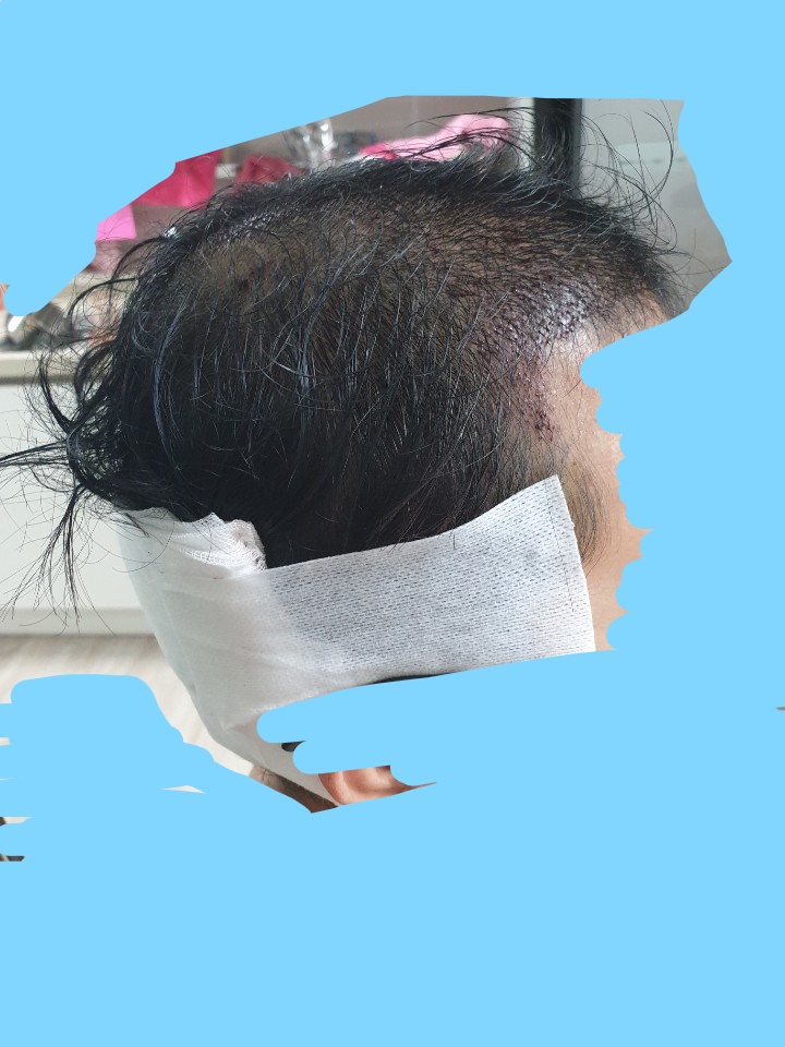 Inked모발이식후 2-2.jpg