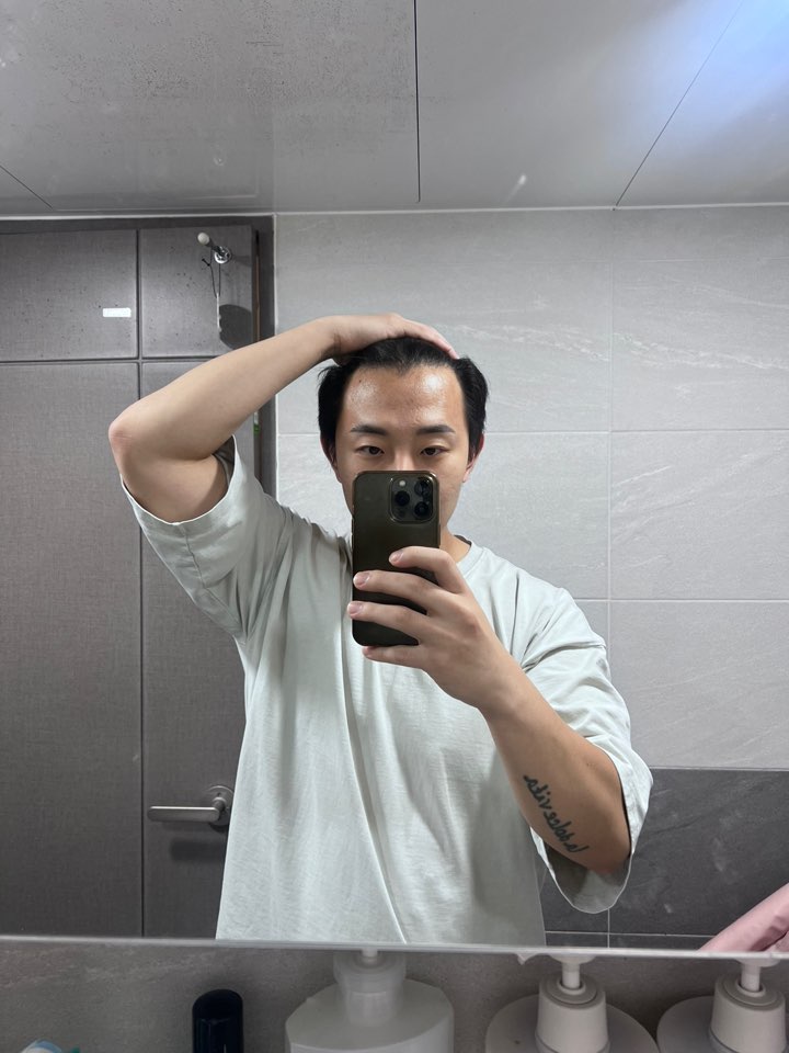 고민중이라면 꼭 보고가세요! 비절개모발이식 문건학원장님 11개월 차 후기
